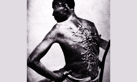 Cicatrices de flagellation sur un esclave 