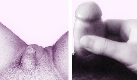 micro pénis micro penis